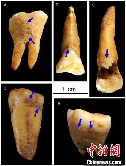 湖南道縣福巖洞8-12萬年前古人類的牙結(jié)石?！清?供圖