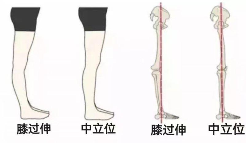 膝過伸是什么?